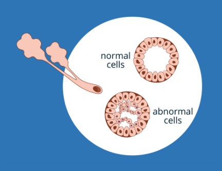 Diagram showing normal cells and abnormal cells